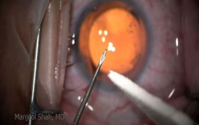 XEN® Implantation Procedure